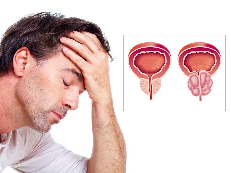 adenom de prostată cu impotență